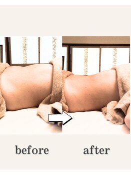 フローラ(FLORA)/施術ビフォーアフター