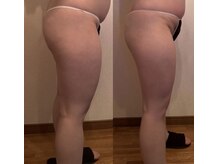 ルナ(Luna)/下半身脂肪＆セルライト２回効果