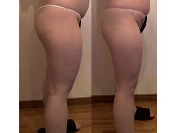 ルナ(Luna)/下半身脂肪&セルライト2回効果