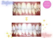 エクシアホワイトニング 天王寺店/ホワイトニングビフォーアフター
