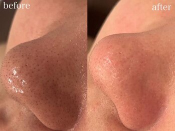 ホワイトアクア 京橋店(WHITE AQUA)の写真/【肌質改善・毛穴・ニキビケアはお任せください】毛穴洗浄/ハーブ/ララピールで理想のツルスベ肌へ♪