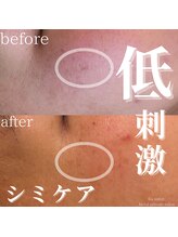 アールエーサロン 恵比寿 広尾(Ra salon)/シミケア3回目でのbefore/after