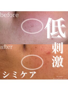 アールエーサロン 恵比寿 広尾(Ra salon)/シミケア3回目でのbefore/after