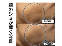 グレースティー 森町 箕面/頬のシミが改善★