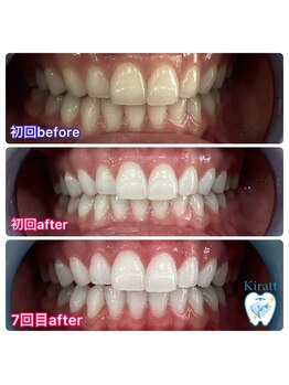 キラット 札幌中島公園店(Kiratt)/20代女性リピーター様