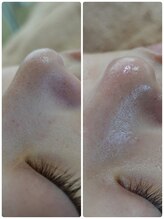 グロウ 脱毛サロン(GLOW)/毛穴洗浄