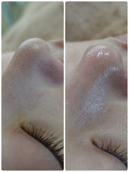 グロウ 脱毛サロン(GLOW)/毛穴洗浄