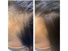 アンジュールの家(unjour no ie)/ヘア増毛