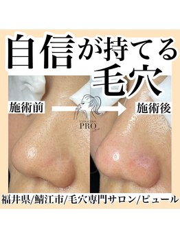 ピュール 鯖江店(PUR)/毛穴サロン/毛穴ケア/毛穴洗浄