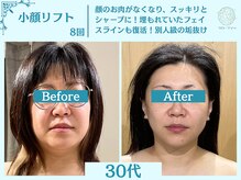 フローフシ∞/【小顔】切らない小顔リフト