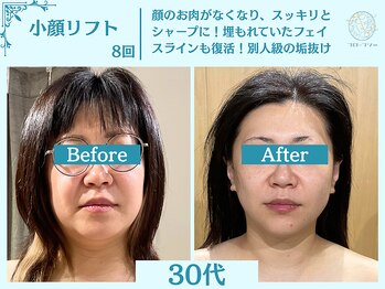フローフシ∞/【小顔】切らない小顔リフト