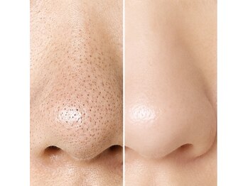 アールアンドエス(R&S)の写真/気になる鼻の黒ずみ・毛穴洗浄でスッキリ！夏前に透明感あふれるツヤ肌へ★