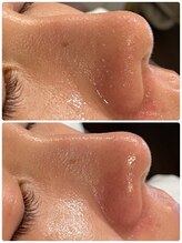 ハーシークレット(Her secret)/ハイドラ毛穴洗浄