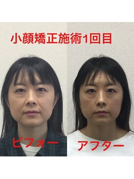 オズ六本木/六本木小顔矯正(造顔)施術1回