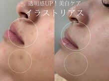 ラシュール(Rassure)/イラストリアス before/after