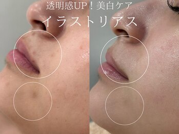 ラシュール(Rassure)/イラストリアス before/after