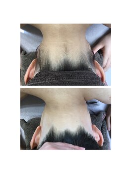 ミース 熊本店/うなじ矯正◆ビフォーアフター