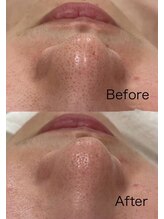 ルル 北仙台/お客様Before/After　毛穴
