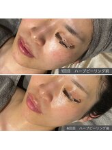 ロッタ エクリュ(Lotta ecru+)/剥けないハーブピーリング