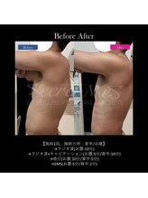 フェレザ 新潟(Felleza)/お腹ぽっこり撃退エステ