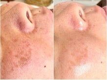 ルラシェ(Relacher)/ハーブピーリング×ポレーション