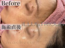 マシェリ(macherie)/クリスティーナの最強美白!