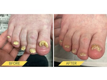 ふっとけ庵/肥厚爪ケア