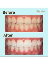 ホワイトニングサロン Blanche 心斎橋店/ビフォーアフター