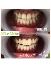 ルブラン 奈良店(Le Blanc)/2回照射後！