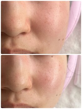 アスピリア(aspirer a')/ハーブピーリング