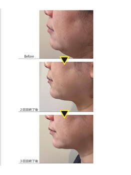 クリスタル(CRYSTAL)/レモンボトル