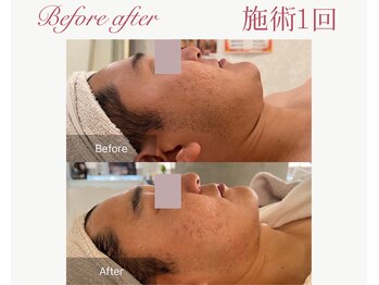 パルタージュ 三宮(Partage)/メンズフェイシャル♪