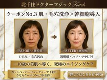 毛穴専業、角質ピーリング、ヒト幹細胞美肌エイジングケア