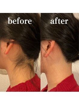 ミノア 大野城店(MINOA)/うなじ脱毛◆ビフォーアフター