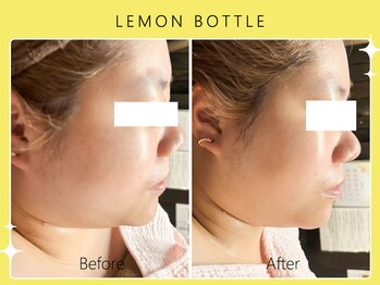 ハノハノ 八代店(HANO HANO)/【八代初導入!】レモンボトル☆