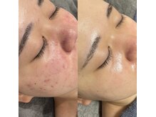 レクシア(LEXIA)/肌質改善症例｜赤ニキビ