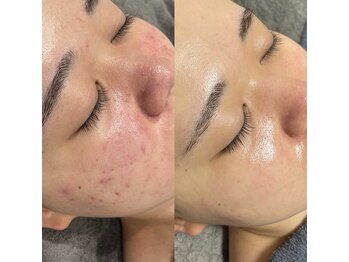 レクシア(LEXIA)/肌質改善症例｜赤ニキビ