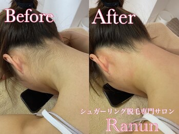 ラナン(Ranun)/生えてきてもチクチクしない脱毛