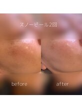 WA ネイル アンド ビューティー(WA nail & beauty)/ホワイトスノーピール2回