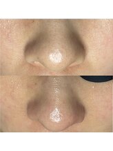 エヌ ドット ジュウイチ(N.11)/黒ずみ毛穴洗浄