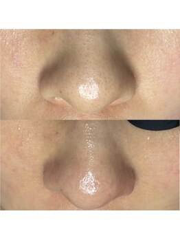 エヌ ドット ジュウイチ(N.11)/黒ずみ毛穴洗浄