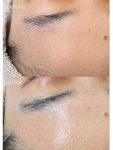 エルピス(ELPIS)/おでこWax脱毛