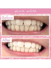 エクシアホワイトフジ(ecxia white fuji)/ホワイトニングビフォーアフター