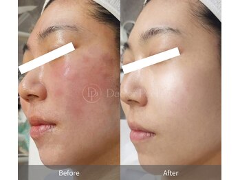 ミベル(MeBell)/ダクトピール　赤み/くすみ