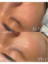 ルミア(LUMiA)/1度の施術で毛穴がキレイに♪