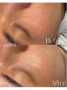 ルミア(LUMiA)/1度の施術で毛穴がキレイに♪