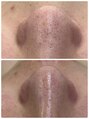 ルコル(LUCOL) wax脱毛やるのもやられるのもすき!