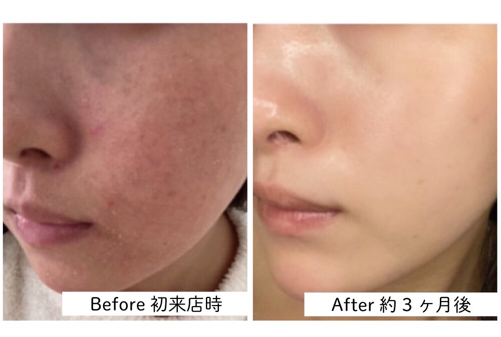 肌質改善エステサロン♡ サルヴァトーレ 長崎｜ホットペッパービューティー