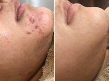 ハダイ(HADAY)/ニキビ改善｜ハーブピーリング