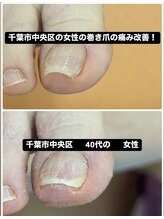 巻き爪じゅん 千葉駅前店/女性方の巻き爪による痛みが改善